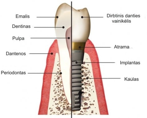 Dantų implantai schemoje